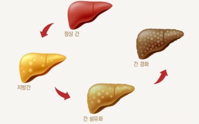 건강검진으로 발견되는 지방간 방치해도 괜찮은가?